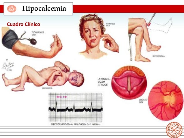 Hipocalcemia