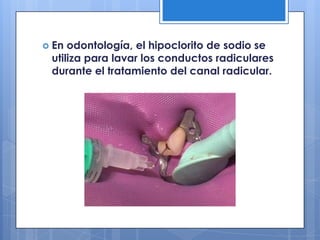 En odontología, el hipoclorito de sodio se utiliza para lavar los conductos radiculares durante el tratamiento del canal radicular. 