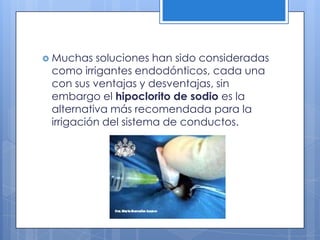 Muchas soluciones han sido consideradas como irrigantes endodónticos, cada una con sus ventajas y desventajas, sin embargo el hipoclorito de sodio es la alternativa más recomendada para la irrigación del sistema de conductos.