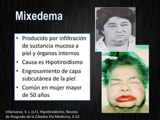 • Producido por infiltración
de sustancia mucosa a
piel y órganos internos
• Causa es Hipotiroidismo
• Engrosamiento de capa
subcutánea de la piel
• Común en mujer mayor
de 50 años
Villanueva, V. J. (s.f.). Hipotiroidismo. Revista
de Posgrado de la Cátedra VIa Medicina, 3-12.
 