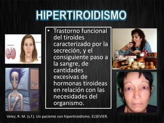 • Trastorno funcional
del tiroides
caracterizado por la
secreción, y el
consiguiente paso a
la sangre, de
cantidades
excesivas de
hormonas tiroideas
en relación con las
necesidades del
organismo.
Velez, R. M. (s.f.). Un paciente con hipertiroidismo. ELSEVIER.
 