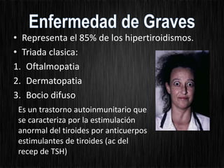• Representa el 85% de los hipertiroidismos.
• Triada clasica:
1. Oftalmopatia
2. Dermatopatia
3. Bocio difuso
Es un trastorno autoinmunitario que
se caracteriza por la estimulación
anormal del tiroides por anticuerpos
estimulantes de tiroides (ac del
recep de TSH)
 