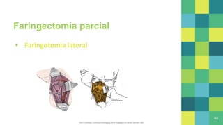 Faringectomia parcial
▪ Faringotomia lateral
48
Flint P, CummingsC. Cummingsotolaryngology.7th ed. Philadelphia,Pa: Elsevier, Saunders;2020.
 