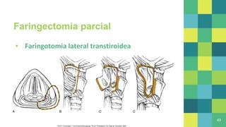 Faringectomia parcial
▪ Faringotomia lateral transtiroidea
49
Flint P, Cummings C. Cummings otolaryngology. 7th ed. Philadelphia, Pa: Elsevier, Saunders; 2020
 