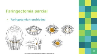 Faringectomia parcial
▪ Faringotomia transhiodea
50
Flint P, Cummings C. Cummings otolaryngology. 7th ed. Philadelphia, Pa: Elsevier, Saunders; 2020
 