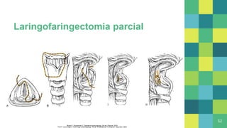 Laringofaringectomia parcial
52
Flint P, Cummings C. Cummings otolaryngology. 7th ed. Philadelphia, Pa: Elsevier, Saunders; 2020
Myers E, Snyderman C. Operative otolaryngology. 3rd ed. Elsevier; 2018
 