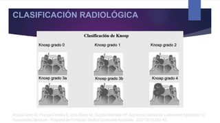 Araujo-Castro M, Pascual-Corrales E, Ortiz-Flores AE, Escobar-Morreale HF. Adenomas hipofisarios y adenomas hipofisarios no
funcionantes. Medicine - Programa de Formación Médica Continuada Acreditado. 2020;13(15):833–45.
CLASIFICACIÓN RADIOLÓGICA
 