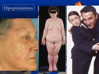 Hipopituitarismo
 
