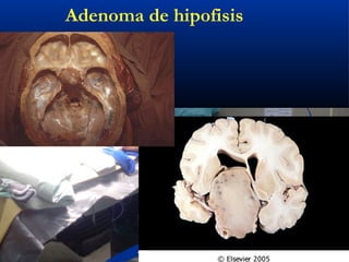 Antonio Ferrández Izquierdo
Adenoma de hipofisis
 