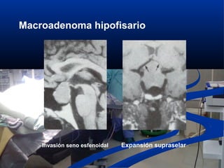 Macroadenoma hipofisario
Expansión supraselarInvasión seno esfenoidal
 