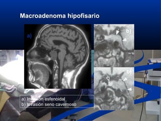 Macroadenoma hipofisario
a) Invasión esfenoidal
b) Invasión seno cavernoso
a)
b)
b)
 