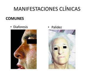 COMUNES
• Diaforesis
MANIFESTACIONES CLÍNICAS
• Palidez
 