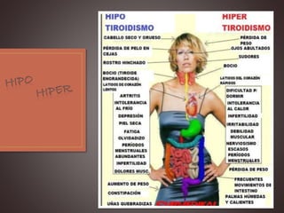 Hipotiroidismo  hipertiroidismo 