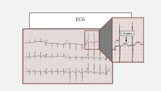 ECG
• ↓segmento ST
• ↓onda T
• ↑onda U (V4-V6)
• ↑duración complejo QRS (grave)
 