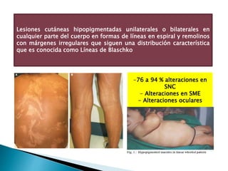Lesiones cutáneas hipopigmentadas unilaterales o bilaterales en 
cualquier parte del cuerpo en formas de líneas en espiral y remolinos 
con márgenes irregulares que siguen una distribución característica 
que es conocida como Líneas de Blaschko 
-76 a 94 % alteraciones en 
SNC 
- Alteraciones en SME 
- Alteraciones oculares 
 