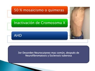 50 % mosaicismo o quimeras 
Inactivación de Cromosoma X 
AHD 
3er Desorden Neurocutaneo mas común, después de 
Neurofibromatosis y Esclerosis tuberosa 
 