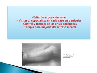 -Evitar la exposición solar 
- Visitar al especialista en cada caso en particular 
- Control y manejo de las crisis epilépticas 
- Terapia para mejoría del retraso mental 
 