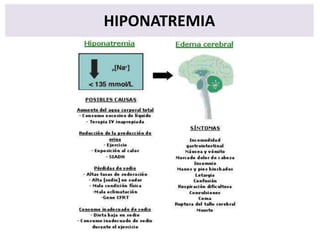 HIPONATREMIA

 