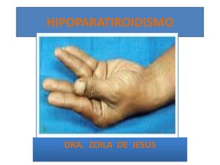 HIPOPARATIROIDISMO




  DRA. ZOILA DE JESUS
 