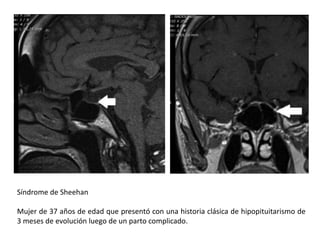 Síndrome de Sheehan
Mujer de 37 años de edad que presentó con una historia clásica de hipopituitarismo de
3 meses de evolución luego de un parto complicado.
 