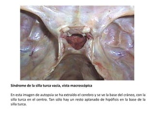 Síndrome de la silla turca vacía, vista macroscópica
En esta imagen de autopsia se ha extraído el cerebro y se ve la base del cráneo, con la
silla turca en el centro. Tan sólo hay un resto aplanado de hipófisis en la base de la
silla turca.
 