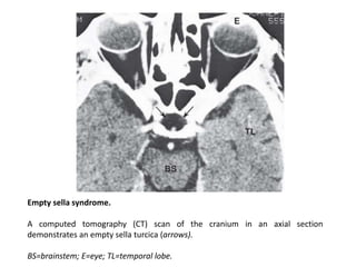 Empty sella syndrome.
A computed tomography (CT) scan of the cranium in an axial section
demonstrates an empty sella turcica (arrows).
BS=brainstem; E=eye; TL=temporal lobe.
 