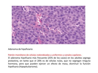 Adenoma de hipofisiario
Patrón monótono de células redondeadas y uniformes y canales capilares.
El adenoma hipofisario más frecuente (25% de los casos) en los adultos segrega
prolactina, en tanto que el 20% es de células nulas, que no segregan ninguna
hormona, pero que pueden ejercer un efecto de masa, disminuir la función
hipofisaria (hipopituitarismo).
 