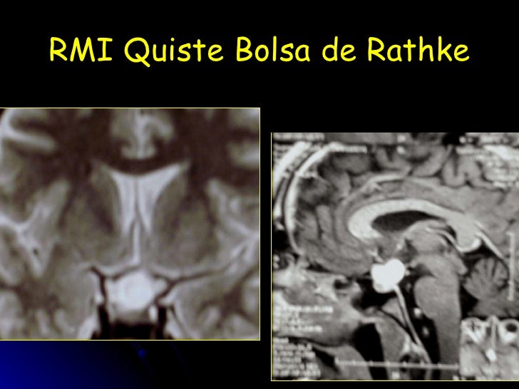 Kyste De La Poche De Rathke Opération
