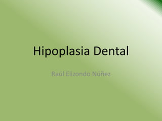 Hipoplasia Dental
   Raúl Elizondo Núñez
 