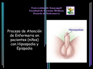 Universidad de Guayaquil
            Facultad de Ciencias Médicas
               Escuela de Enfermería




Proceso de Atención
 de Enfermeria en
  pacientes (niños)
  con Hipospadia y
      Epispadia
 