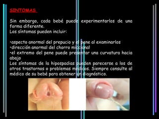 SINTOMAS

Sin embargo, cada bebé puede experimentarlos de una
forma diferente.
Los síntomas pueden incluir:

•aspecto anormal del prepucio y el pene al examinarlos
•dirección anormal del chorro miccional
•el extremo del pene puede presentar una curvatura hacia
abajo
Los síntomas de la hipospadias pueden parecerse a los de
otros trastornos o problemas médicos. Siempre consulte al
médico de su bebé para obtener un diagnóstico.
 
