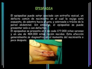 EPISPADIA

El epispadias puede estar asociado con extrofia vesical, un
defecto común de nacimiento en el cual la vejiga está
expuesta, de adentro hacia afuera, y sobresale a través de la
pared abdominal. Sin embargo, el epispadias se puede
presentar solo o con defectos.
El epispadias se presenta en 1 de cada 177.000 niños varones
y en una de 484.000 niñas recién nacidos. Esta afección
generalmente se diagnostica en el momento del nacimiento o
poco después.
 