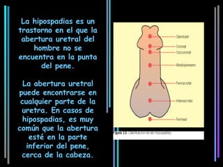 La hipospadias es un
trastorno en el que la
 abertura uretral del
    hombre no se
encuentra en la punta
       del pene.

  La abertura uretral
puede encontrarse en
 cualquier parte de la
 uretra. En casos de
 hipospadias, es muy
común que la abertura
    esté en la parte
   inferior del pene,
 cerca de la cabeza.
 