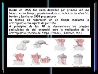 Russel en 1900 fue quien describió por primera vez una
técnica en un tiempo, popularizandose a finales de los años 50.
Horton y Devine en 1959 presentaron
su técnica de reparación en un tiempo mediante la
uretroplastia con injerto de piel total.
A principios de los 70 se desarrollaron los colgajos
pediculados de piel prepucial para la realización de la
uretroplastia (técnica de Asopa, Standoli, Hinderer, etc.).
 