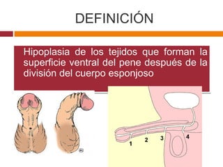 DEFINICIÓN
 Hipoplasia de los tejidos que forman la
superficie ventral del pene después de la
división del cuerpo esponjoso
 Hipoplasia de los tejidos que forman la
superficie ventral del pene después de la
división del cuerpo esponjoso
 