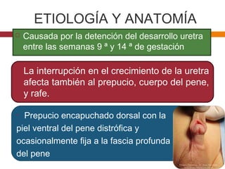 ETIOLOGÍA Y ANATOMÍA
 Causada por la detención del desarrollo uretra
entre las semanas 9 ª y 14 ª de gestación
• La interrupción en el crecimiento de la uretra
afecta también al prepucio, cuerpo del pene,
y rafe.
• Prepucio encapuchado dorsal con la
piel ventral del pene distrófica y
ocasionalmente fija a la fascia profunda
del pene
 