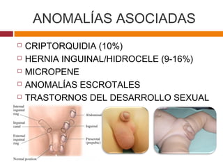 ANOMALÍAS ASOCIADAS
 CRIPTORQUIDIA (10%)
 HERNIA INGUINAL/HIDROCELE (9-16%)
 MICROPENE
 ANOMALÍAS ESCROTALES
 TRASTORNOS DEL DESARROLLO SEXUAL
(≤30%)
 