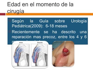 Edad en el momento de la
cirugía
 Según la Guía sobre Urología
Pediátrica(2009): 6‑18 meses
 Recientemente se ha descrito una
reparación mas precoz, entre los 4 y 6
meses de edad
 