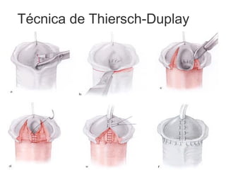 Técnica de Thiersch‑Duplay
 