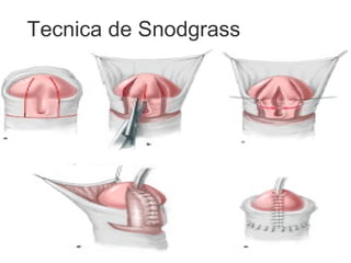 Tecnica de Snodgrass
 