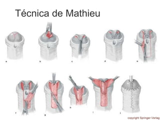 Técnica de Mathieu
 