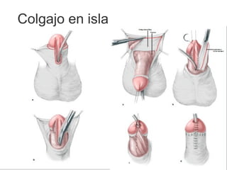 Colgajo en isla
 