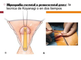  Hipospadia escrotal o penoescrotal grave: la
tecnica de Koyanagi o en dos tiempos
 