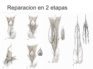 Reparacion en 2 etapas
 