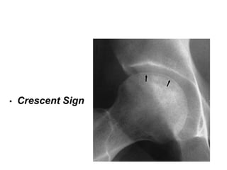 Crescent Sign Avascular Necrosis of Hip | PPTX