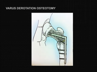 Varus Rotation Osteotomy osteotomies around hip | PPT