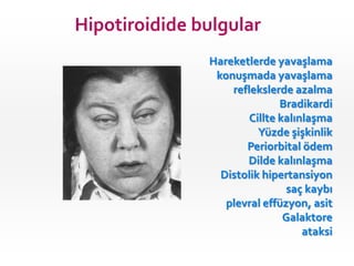 Hipotiroidide bulgular
               Hareketlerde yavaşlama
                konuşmada yavaşlama
                   reflekslerde azalma
                              Bradikardi
                       Cillte kalınlaşma
                         Yüzde şişkinlik
                      Periorbital ödem
                      Dilde kalınlaşma
                 Distolik hipertansiyon
                               saç kaybı
                  plevral effüzyon, asit
                               Galaktore
                                   ataksi
 