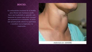 BOCIO.
La estimulación constante de la tiroides
para liberar más hormonas puede
hacer que la glándula se agrande; este
trastorno se conoce como bocio. Aunque
por lo general no es incómodo, un bocio
más grande puede afectar tu apariencia
e interferir con la deglución o la
respiración.
 