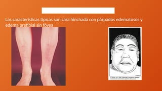 Manifestaciones clínicas
Las características típicas son cara hinchada con párpados edematosos y
edema pretibial sin fóvea
 