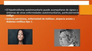 •El hipotiroidismo autoinmunitario puede acompañarse de signos y
síntomas de otras enfermedades autoinmunitarias, particularmente
vitíligo
•anemia perniciosa, enfermedad de Addison, alopecia areata y
diabetes mellitus tipo 1.
Manifestaciones clínicas
 